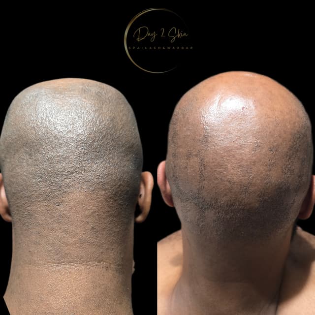 Mens Full Scalp Laser at Day 2 Skin LLC in Fort Oglethorpe, GA