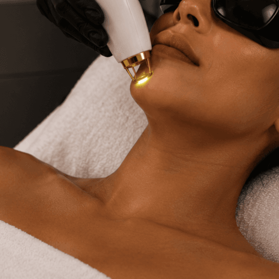 Full Face Laser at Day 2 Skin LLC in Fort Oglethorpe, GA